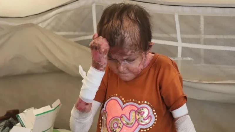 Gazze’de genç kız nadir cilt hastalığıyla mücadele ediyor
