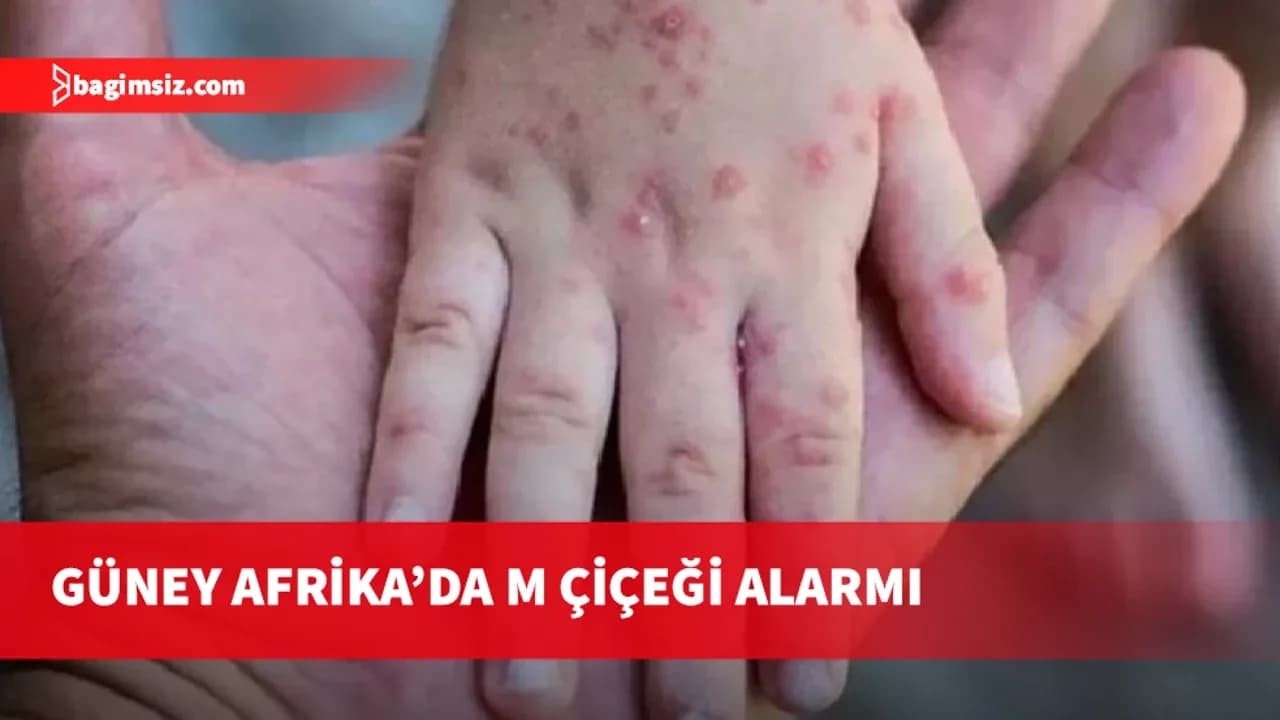 Güney Afrika’da son 5 haftada 13 M çiçeği vakası kaydedildi