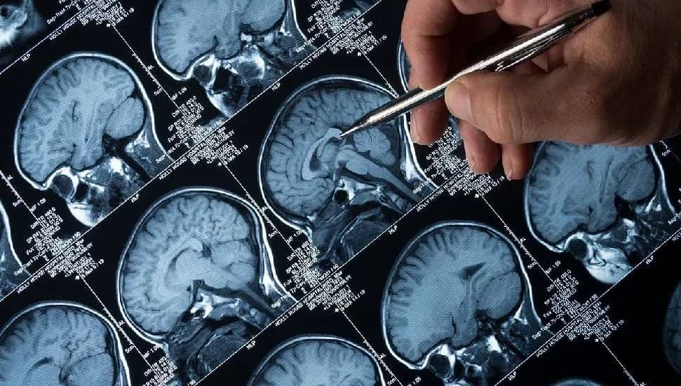 Alzheimer araştırmasında yeni ipucu: Beyne ulaşamayan bağışıklık hücreleri