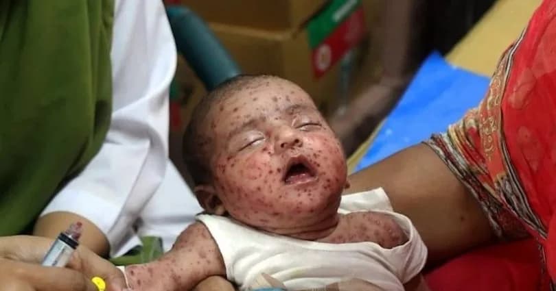 Bangladeş’te kızamık salgını: Ölen çocuk sayısı 1201’e çıktı